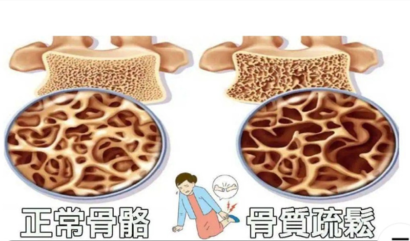 骨质疏松危害大.jpg