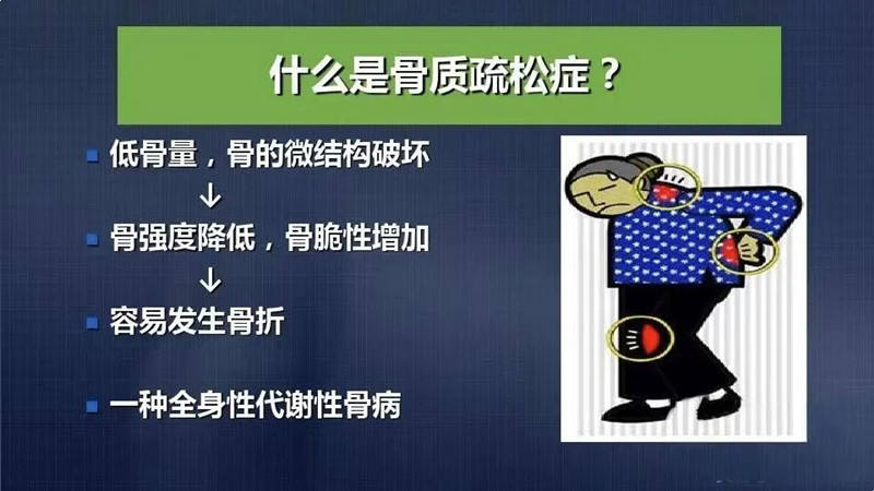 骨质疏松.jpg